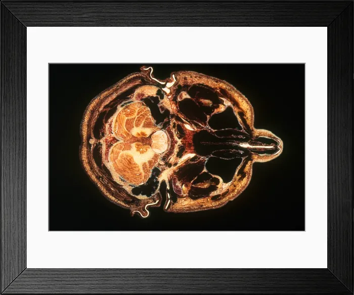 Framed Print : Slice of Human Brain, gross specimen