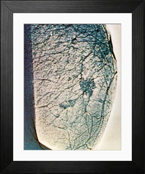 Framed Print : Mammogram showing tumours in the breast tissue Framed Print : Mammogram showing tumours in the breast tissue