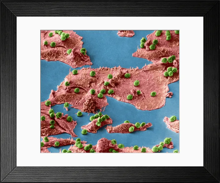 Framed Print : Immune Cells Attacking Cancer Cells, under a microscope (SEM) Framed Print : Immune Cells Attacking Cancer Cells, under a microscope (SEM)
