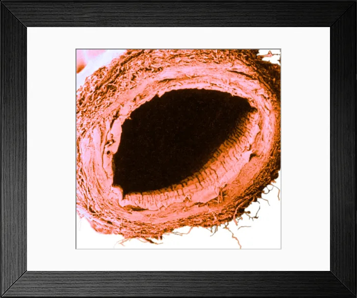 Framed Print : Healthy Vein, under a microscope (SEM) Framed Print : Healthy Vein, under a microscope (SEM)