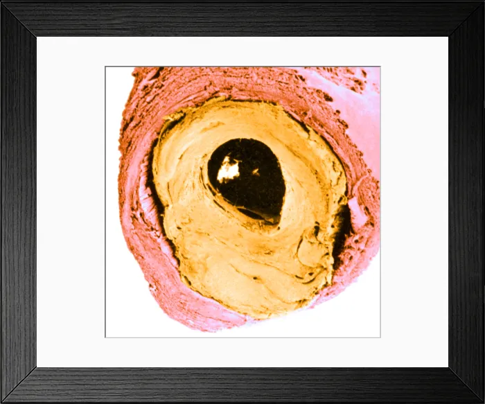 Framed Print : Atherosclerosis SEM, partial blockage
