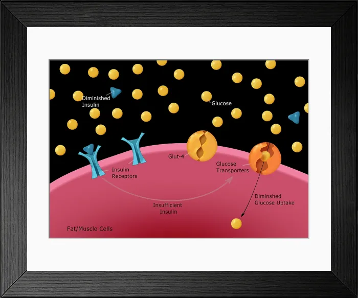 Framed Print : Diagram of type I diabetes, insulin, glucose, receptors, GLUT4 glucose transporters, medical illustration Framed Print : Diagram of type I diabetes, insulin, glucose, receptors, GLUT4 glucose transporters, medical illustration