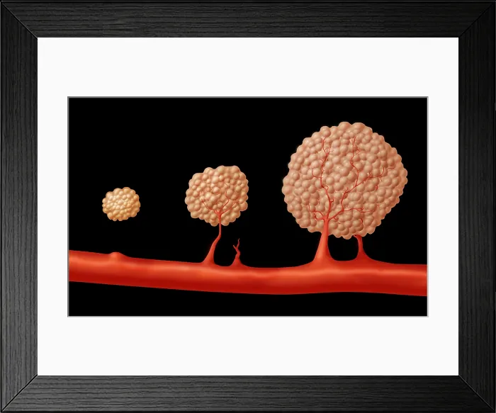 Framed Print : Progression of Angiogenesis Framed Print : Progression of Angiogenesis