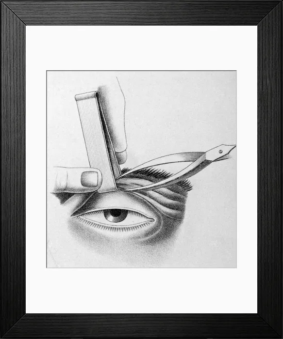 Framed Print : Surgery to Correct Lazy Eyelid, 1830 Framed Print : Surgery to Correct Lazy Eyelid, 1830