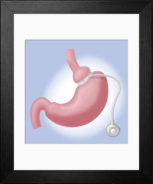 Framed Print : Adjustable Gastric Band