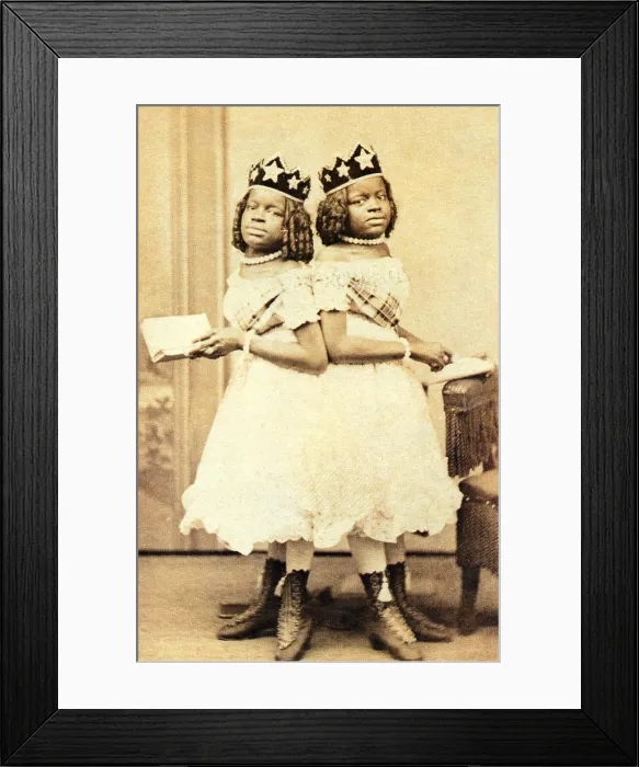 Framed Print : The McCoys, American Conjoined Twins Framed Print : The McCoys, American Conjoined Twins