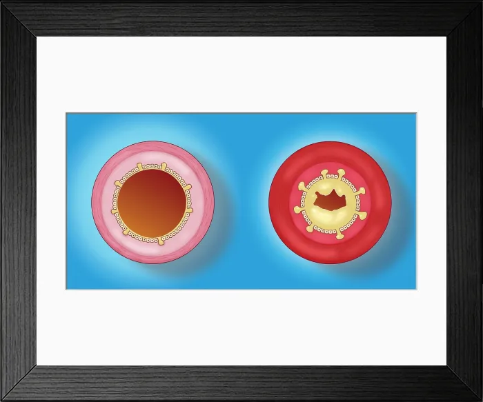 Framed Print : Bronchitis Framed Print : Bronchitis