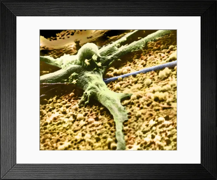 Framed Print : Malignant cancer cell Framed Print : Malignant cancer cell