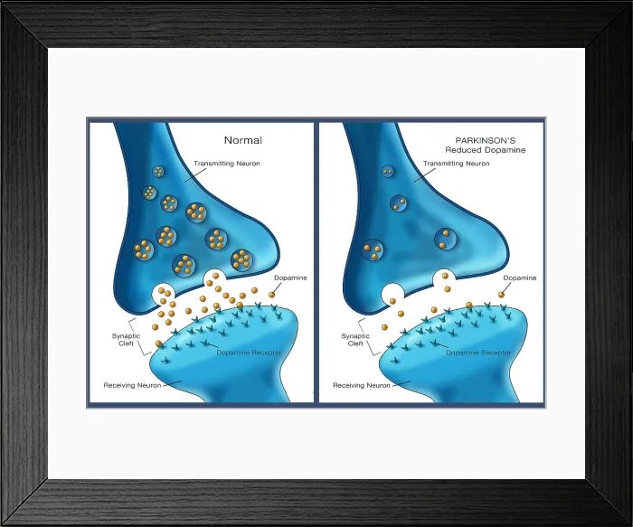 Framed Print : Neuron synapse affected by Parkinson's disease shows diminished dopamine transmission, illustration Framed Print : Neuron synapse affected by Parkinson's disease shows diminished dopamine transmission, illustration