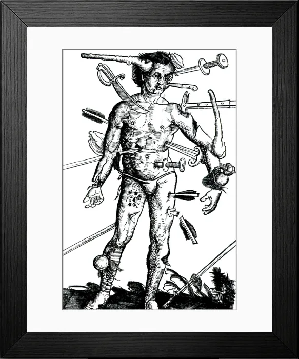 Framed Print : Wound Man, 'Feldbuch der Wundartzney' 1517 Framed Print : Wound Man, 'Feldbuch der Wundartzney' 1517
