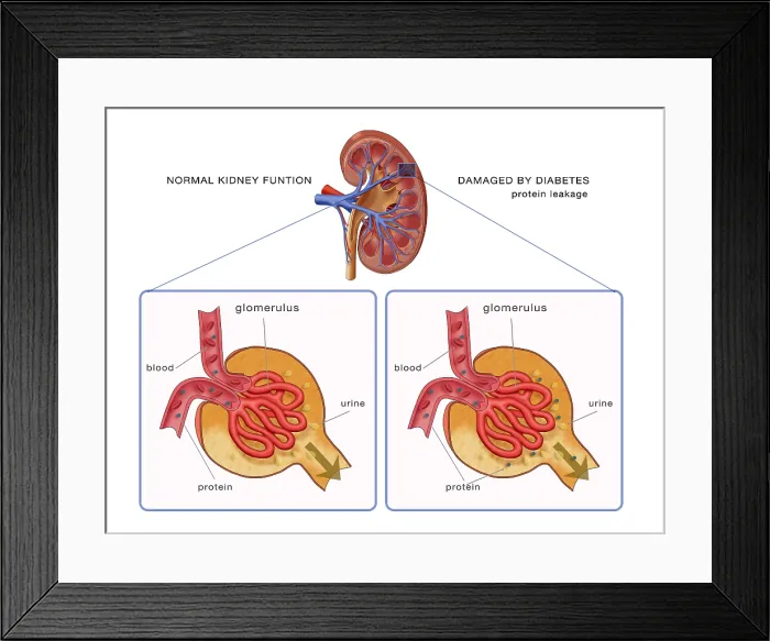 Framed Print : Normal and Diabetes-Damaged Kidneys, Illustration