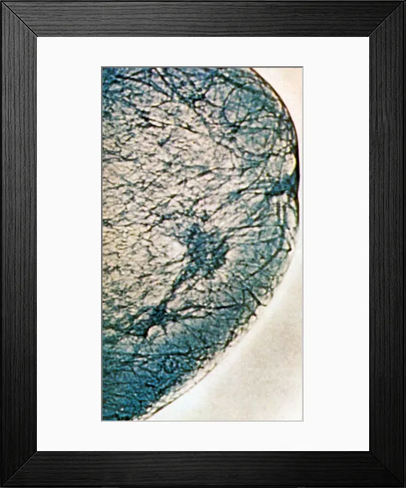 Framed Print : Mammogram showing tumours in the breast tissue Framed Print : Mammogram showing tumours in the breast tissue