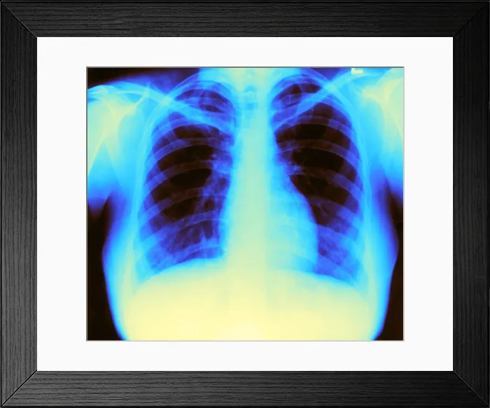 Framed Print : X-ray of Heart and Lungs Framed Print : X-ray of Heart and Lungs