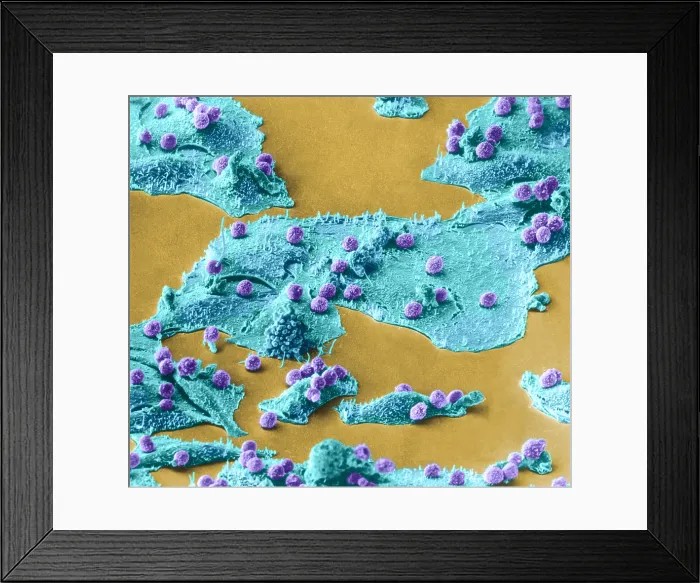 Framed Print : Immune Cells Attacking Cancer Cells, under a microscope (SEM) Framed Print : Immune Cells Attacking Cancer Cells, under a microscope (SEM)