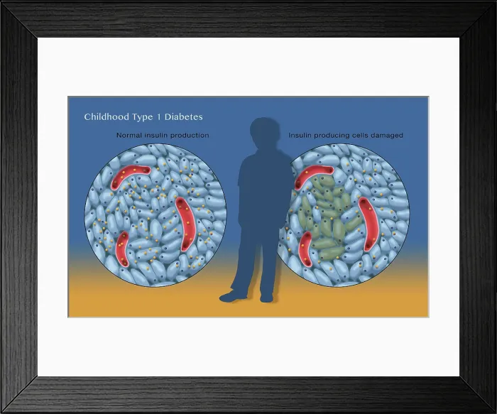 Framed Print : Type 1 Diabetes in Childhood Framed Print : Type 1 Diabetes in Childhood