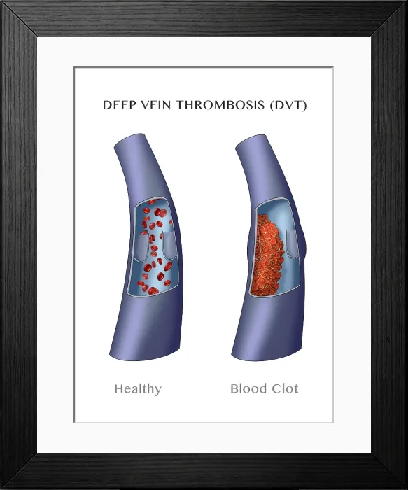 Framed Print : Deep Vein Thrombosis, thrombophlebitis caused by a blood clot, medical Illustration Framed Print : Deep Vein Thrombosis, thrombophlebitis caused by a blood clot, medical Illustration