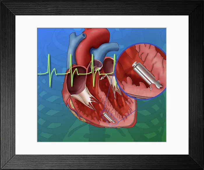 Framed Print : Leadless Pacemaker, Illustration Framed Print : Leadless Pacemaker, Illustration