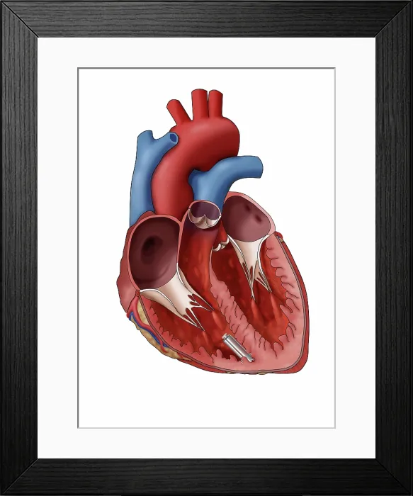 Framed Print : Leadless Pacemaker, Illustration