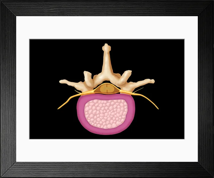 Framed Print : Lumbar Vertebra and Normal Disk Framed Print : Lumbar Vertebra and Normal Disk