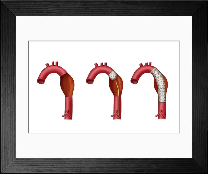 Framed Print : Aortic Aneurysm Stent, Illustration Framed Print : Aortic Aneurysm Stent, Illustration