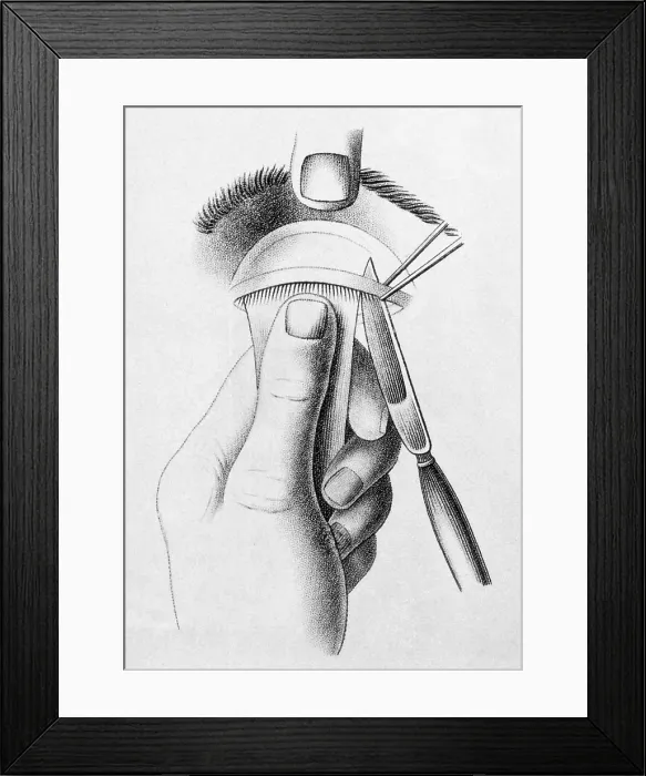 Framed Print : Surgery to Correct Lazy Upper Eyelid, c, 1830 Framed Print : Surgery to Correct Lazy Upper Eyelid, c, 1830
