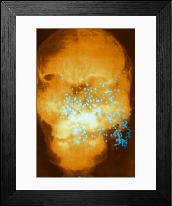 Framed Print : Forensic X-Ray of Murder Victim Framed Print : Forensic X-Ray of Murder Victim