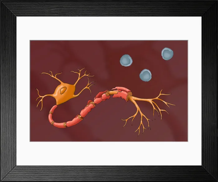 Framed Print : Multiple Sclerosis Framed Print : Multiple Sclerosis