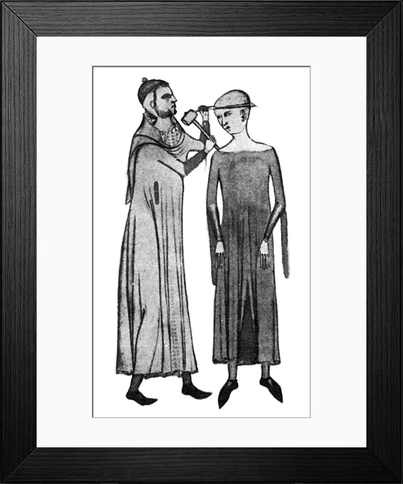 Framed Print : Trepanning, 14th Century Framed Print : Trepanning, 14th Century