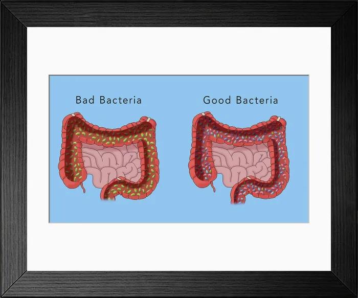 Framed Print : The microbiome of the large intestine, comparison of good and bad bacteria, medical illustration Framed Print : The microbiome of the large intestine, comparison of good and bad bacteria, medical illustration