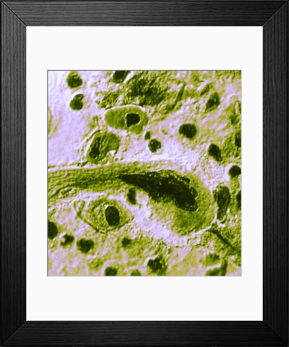 Framed Print : Advanced Lung Cancer Framed Print : Advanced Lung Cancer