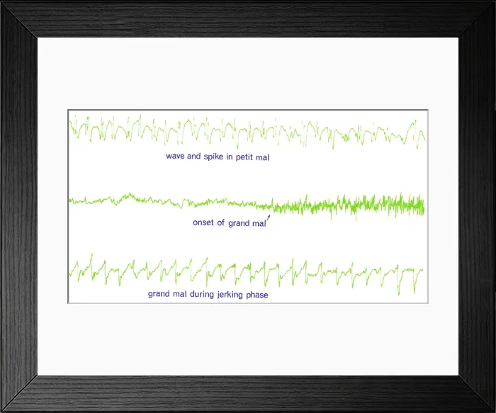 Framed Print : EEG of Epileptic Seizures Framed Print : EEG of Epileptic Seizures