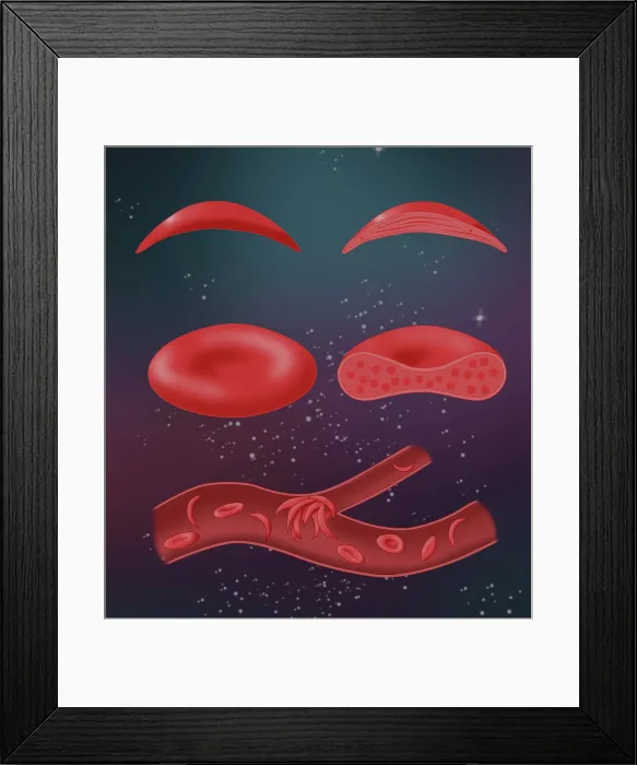 Framed Print : Sickle cell anemia disease, a normal blood cell, a sickle shaped blood cell, a clogged artery or blood vessel Framed Print : Sickle cell anemia disease, a normal blood cell, a sickle shaped blood cell, a clogged artery or blood vessel