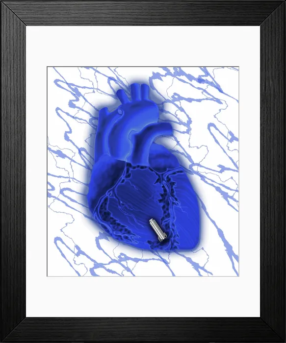 Framed Print : Leadless Pacemaker and Heart Framed Print : Leadless Pacemaker and Heart