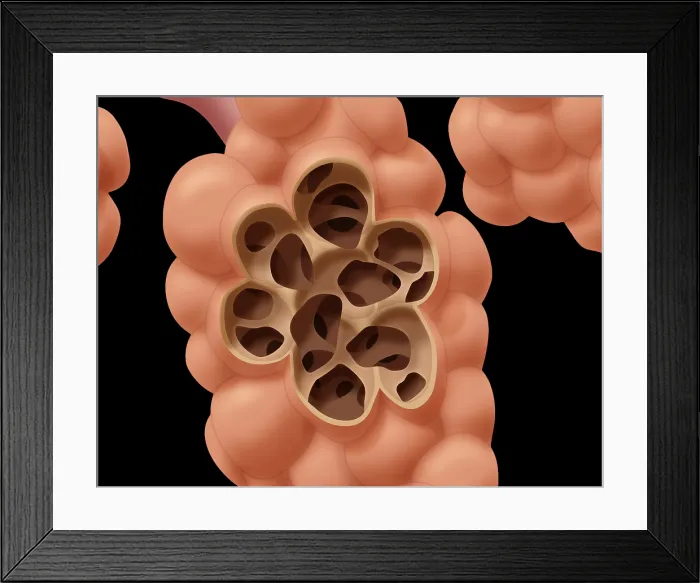 Framed Print : Damaged Alveoli Framed Print : Damaged Alveoli