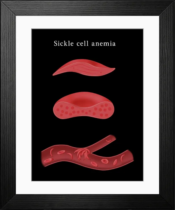 Framed Print : Sickle cell anemia disease, a normal blood cell, a sickle shaped blood cell, a clogged artery or blood vessel, illustration Framed Print : Sickle cell anemia disease, a normal blood cell, a sickle shaped blood cell, a clogged artery or blood vessel, illustration