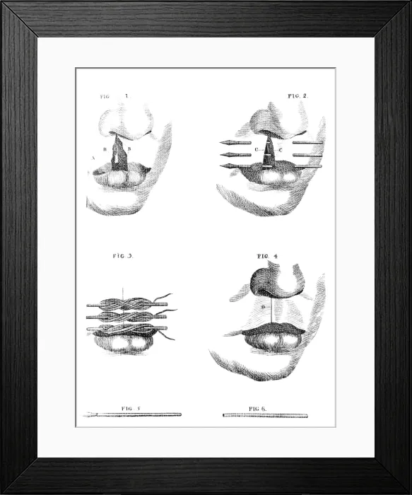 Framed Print : Cleft Lip Surgery, 1791 Framed Print : Cleft Lip Surgery, 1791