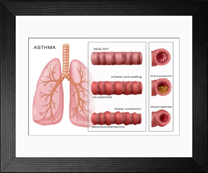 Framed Print : Bronchoconstriction, Asthma Framed Print : Bronchoconstriction, Asthma