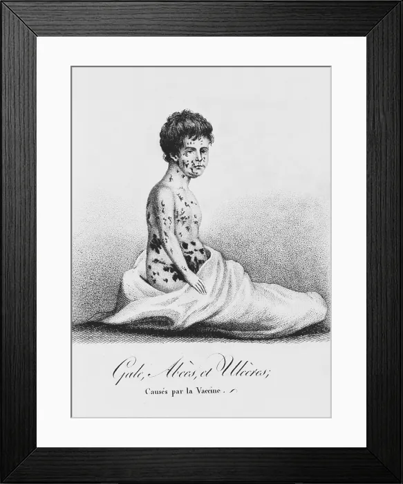 Framed Print : Development of Smallpox after Vaccination, 1807