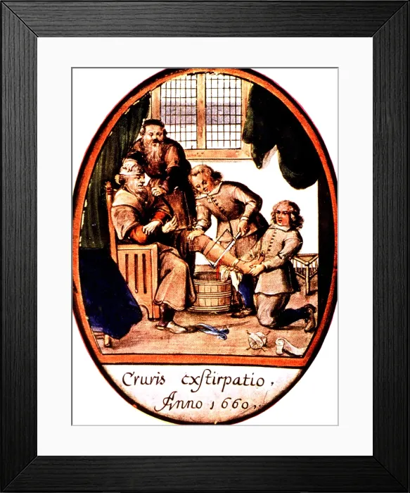 Framed Print : Amputation, 1660 Framed Print : Amputation, 1660