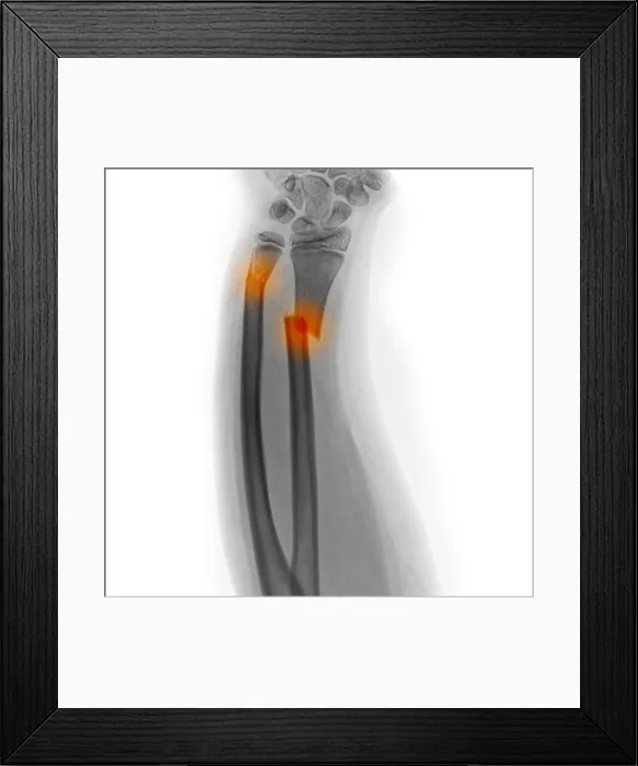 Framed Print : X-ray of Fractured Forearm Framed Print : X-ray of Fractured Forearm