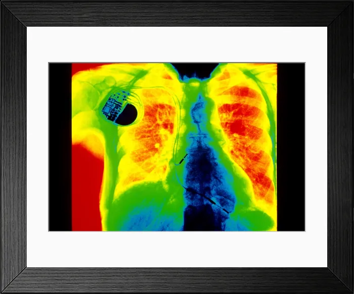 Framed Print : Chest X-Ray Showing Pacemaker Framed Print : Chest X-Ray Showing Pacemaker