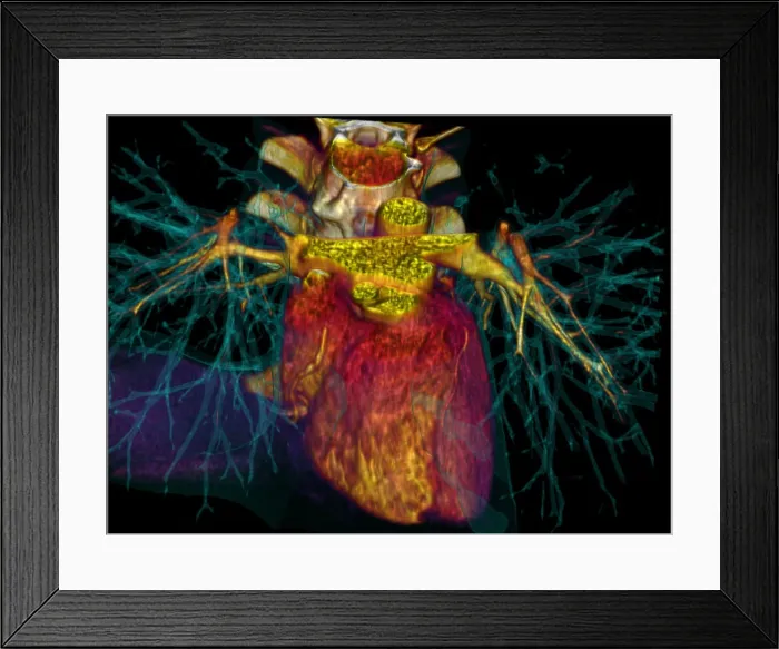 Framed Print : 3D CT Scan of Heart Framed Print : 3D CT Scan of Heart