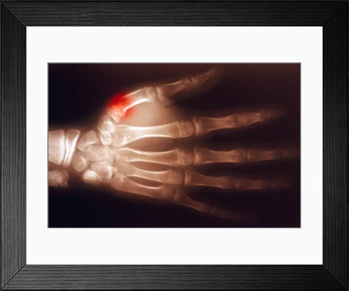 Framed Print : Fractured Thumb, X-ray Framed Print : Fractured Thumb, X-ray