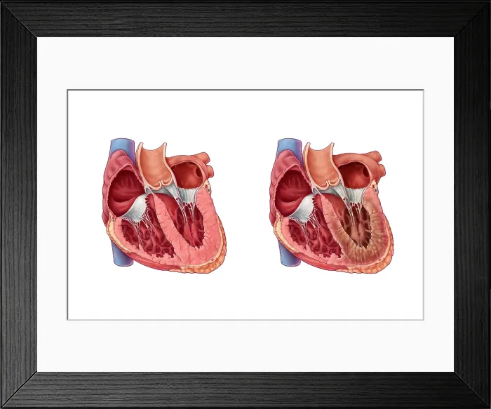 Framed Print : Restrictive Cardiomyopathy Framed Print : Restrictive Cardiomyopathy