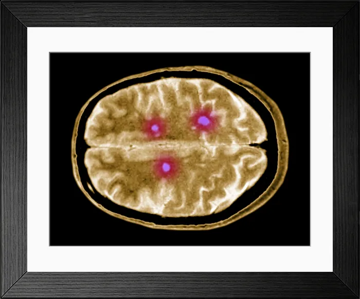 Framed Print : Multiple sclerosis brain lesions Framed Print : Multiple sclerosis brain lesions