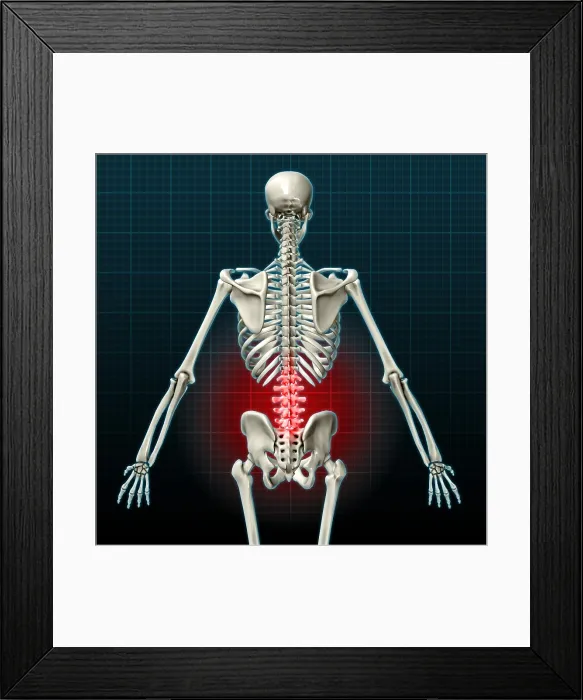 Framed Print : Lower Back Pain, Illustration Framed Print : Lower Back Pain, Illustration