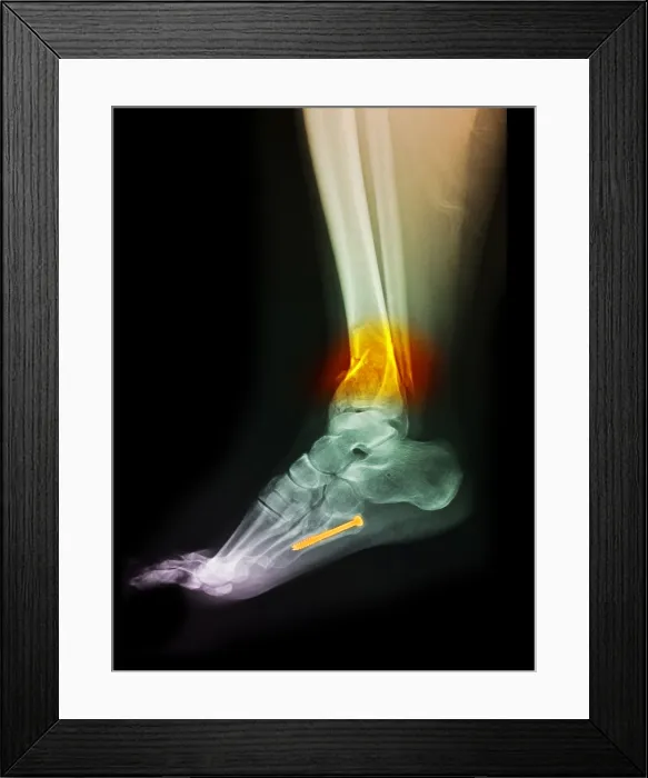 Framed Print : Fractured Ankle Framed Print : Fractured Ankle