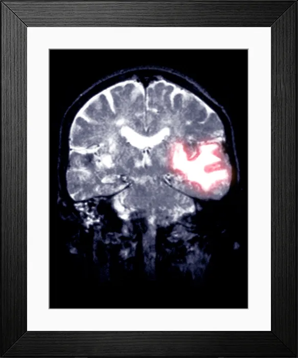 Framed Print : MRI Scan of a Brain Hemorrhage