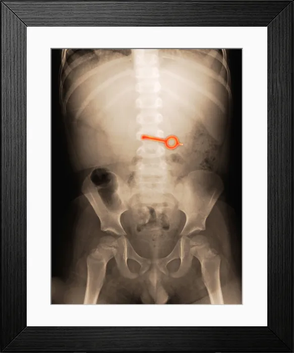 Framed Print : X-ray of Abdomen With Key Framed Print : X-ray of Abdomen With Key