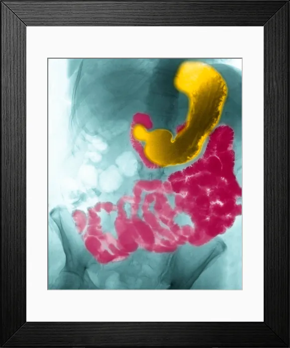 Framed Print : X-ray, Stomach & Intestines